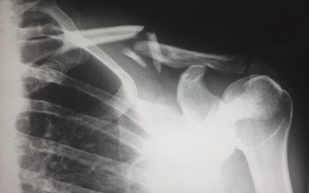 When Are Accidents and Injuries Considered Catastrophic?