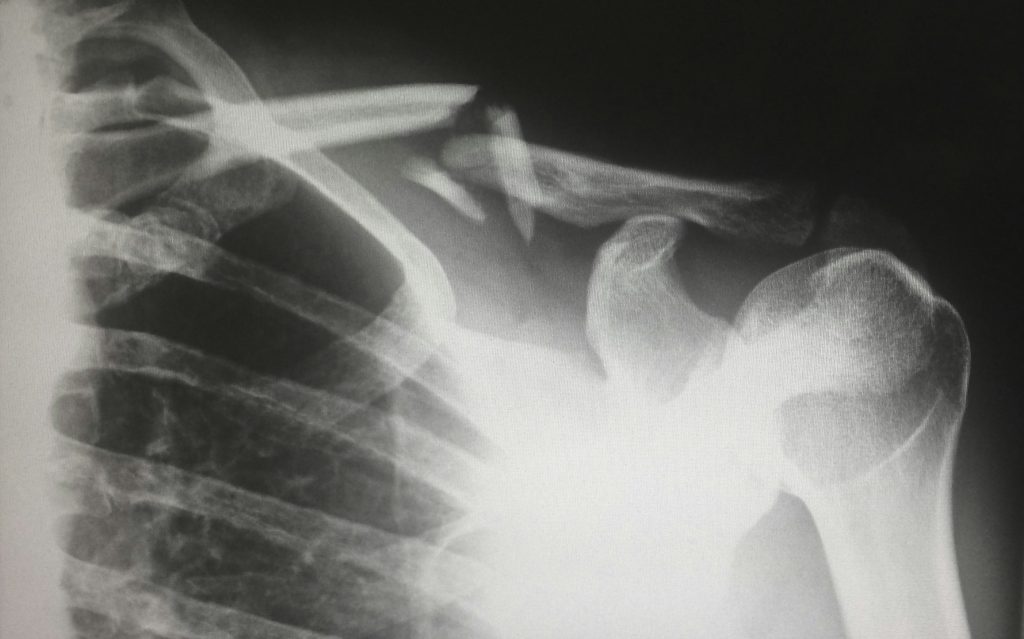 Personal Injury Attorneys in Tacoma, WA
