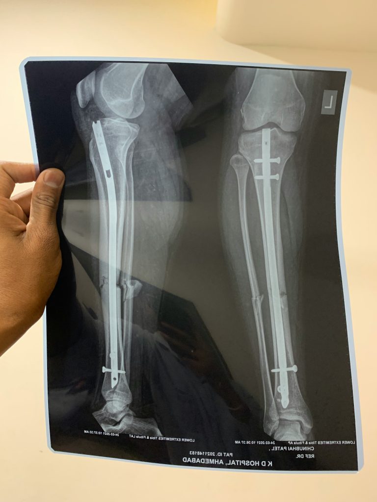 Tacoma Car Accident Attorneys