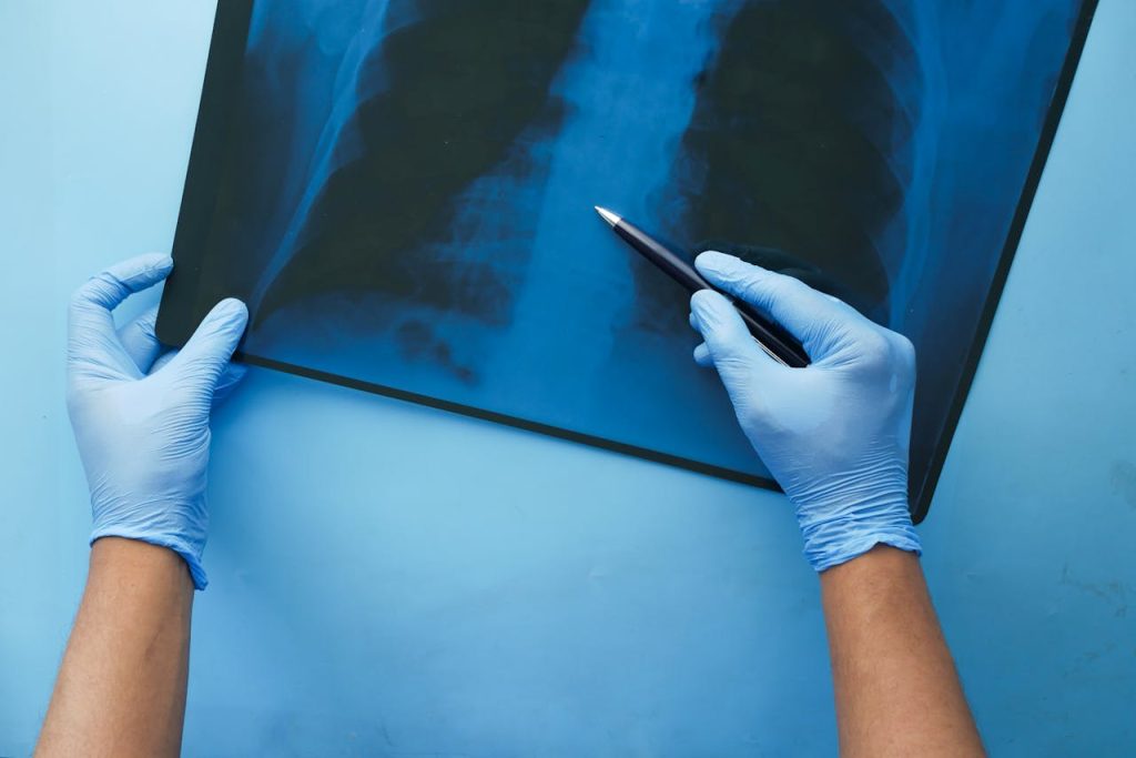 Medical professional in blue gloves examining chest X-ray, illustrating injury diagnosis for personal injury claims.